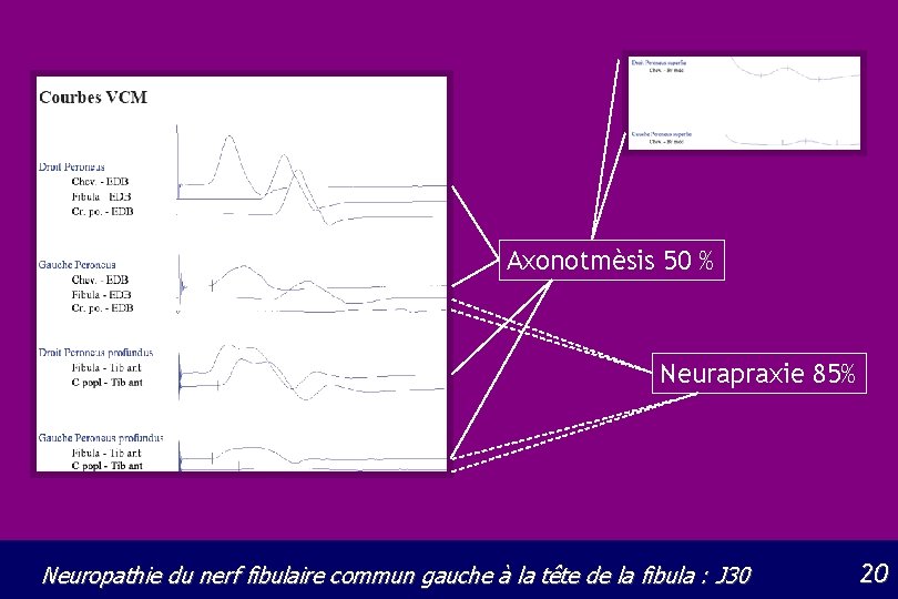 Axonotmèsis 50 % Neurapraxie 85% Neuropathie du nerf fibulaire commun gauche à la tête