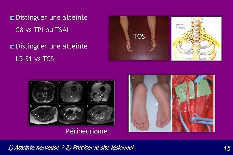 Distinguer une atteinte C 8 vs TPI ou TSAI TOS Distinguer une atteinte L