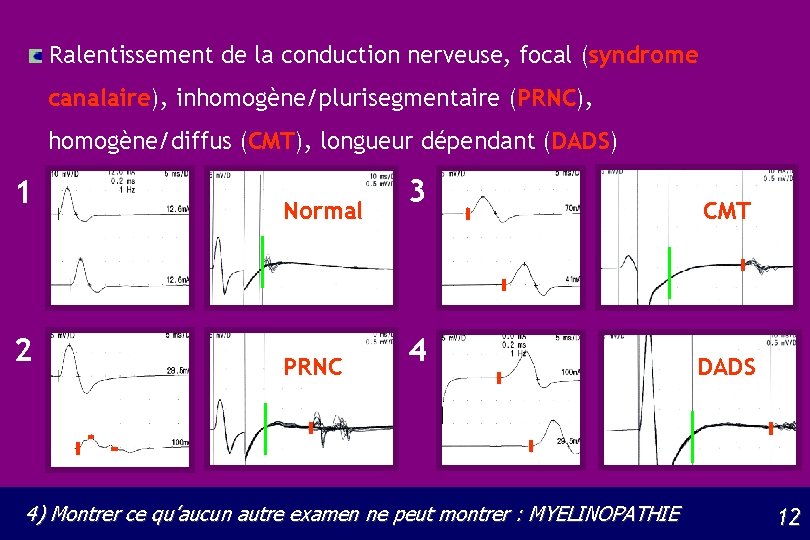 Ralentissement de la conduction nerveuse, focal (syndrome canalaire), inhomogène/plurisegmentaire (PRNC), homogène/diffus (CMT), longueur dépendant