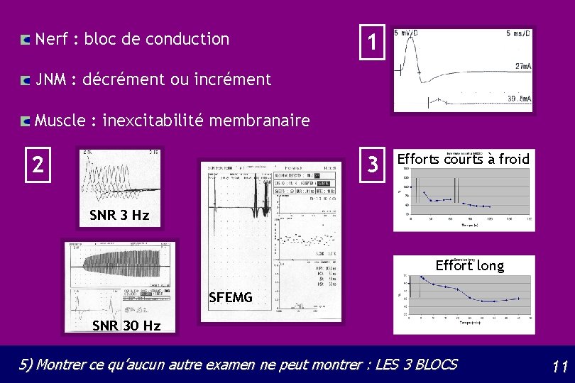 Nerf : bloc de conduction 1 JNM : décrément ou incrément Muscle : inexcitabilité