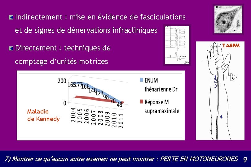 Indirectement : mise en évidence de fasciculations et de signes de dénervations infracliniques TASPM