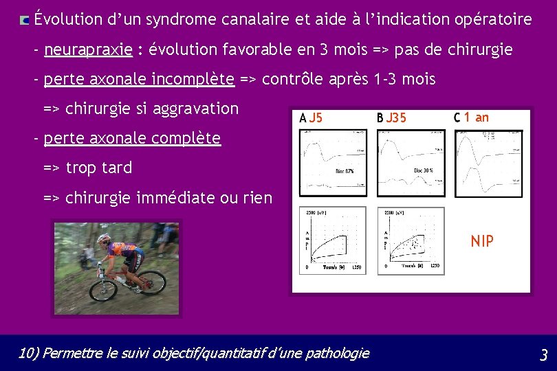 Évolution d’un syndrome canalaire et aide à l’indication opératoire - neurapraxie : évolution favorable