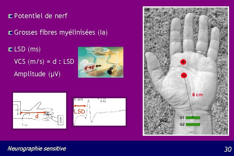 Potentiel de nerf Grosses fibres myélinisées (Ia) LSD (ms) VCS (m/s) = d :