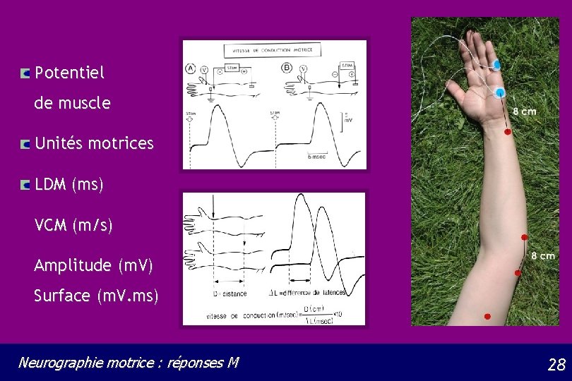 Potentiel de muscle Unités motrices LDM (ms) VCM (m/s) Amplitude (m. V) Surface (m.