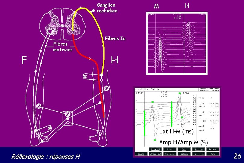 Ganglion rachidien Fibres motrices F M H Fibres Ia H Lat H-M (ms) Amp