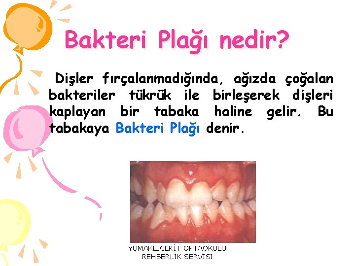 Bakteri Plağı nedir? Dişler fırçalanmadığında, ağızda çoğalan bakteriler tükrük ile birleşerek dişleri kaplayan bir