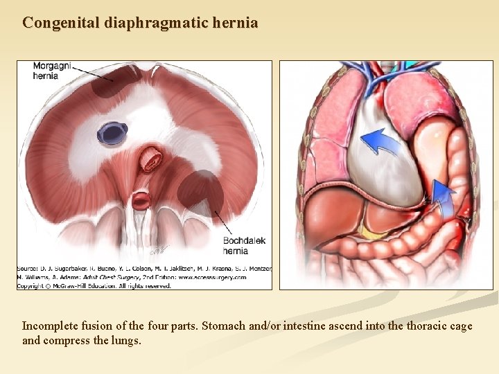 Congenital diaphragmatic hernia Incomplete fusion of the four parts. Stomach and/or intestine ascend into