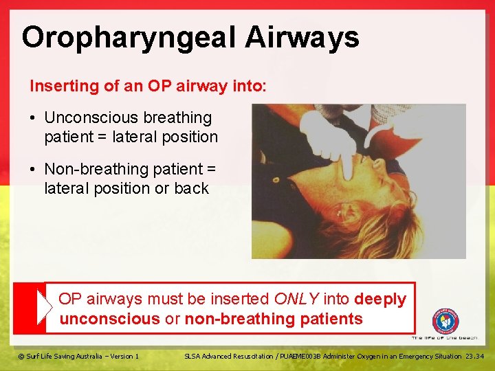 Oropharyngeal Airways Inserting of an OP airway into: • Unconscious breathing patient = lateral