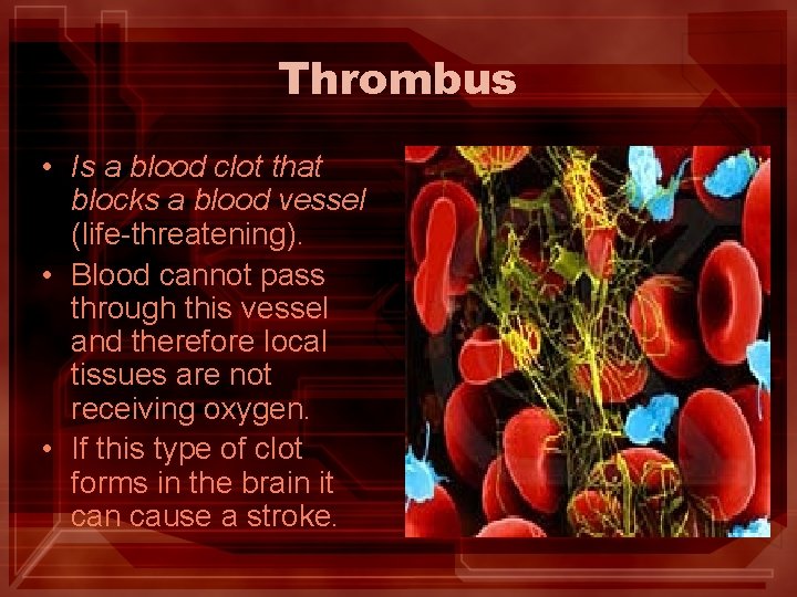 Thrombus • Is a blood clot that blocks a blood vessel (life-threatening). • Blood