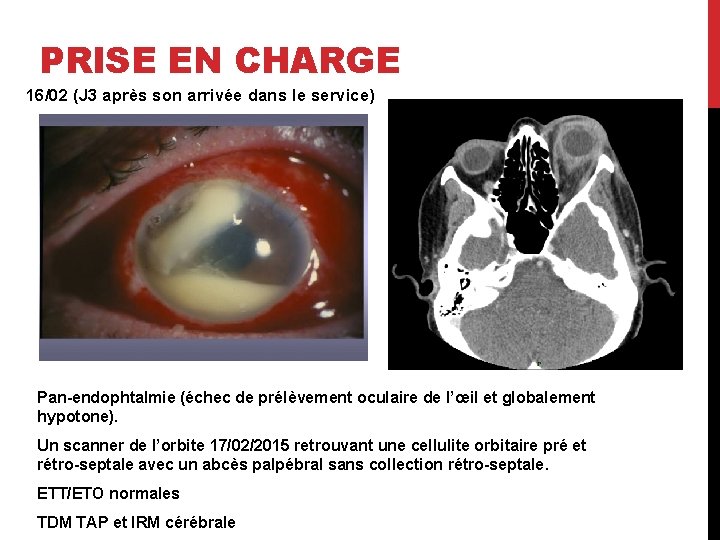 PRISE EN CHARGE 16/02 (J 3 après son arrivée dans le service) Pan-endophtalmie (échec