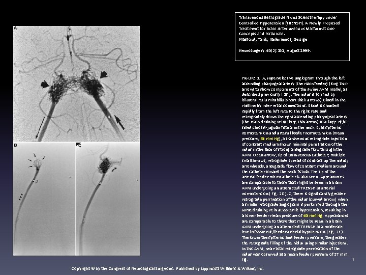 FIGURE 3. Transvenous Retrograde Nidus Sclerotherapy under Controlled Hypotension (TRENSH): A Newly Proposed Treatment