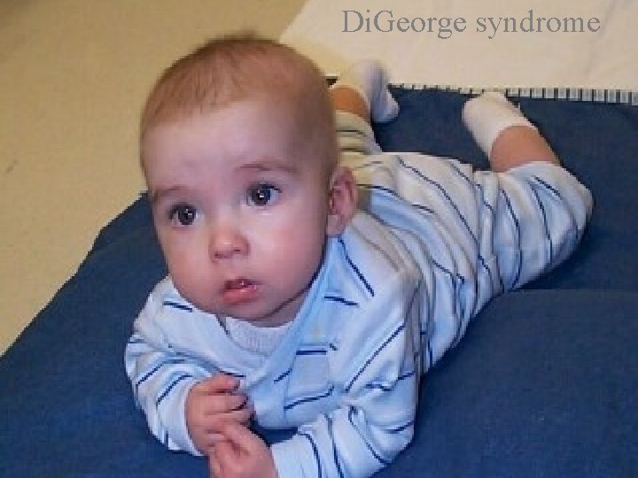 Di. George syndrome Di. George syndrome