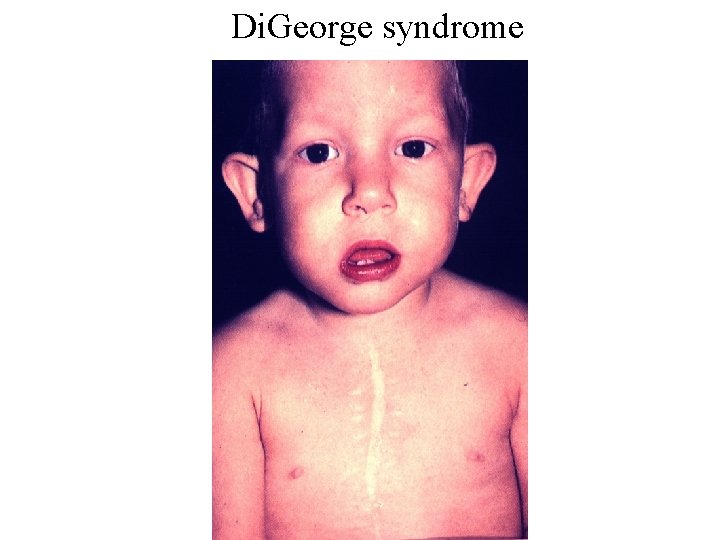 Di. George syndrome Di. George syndrome