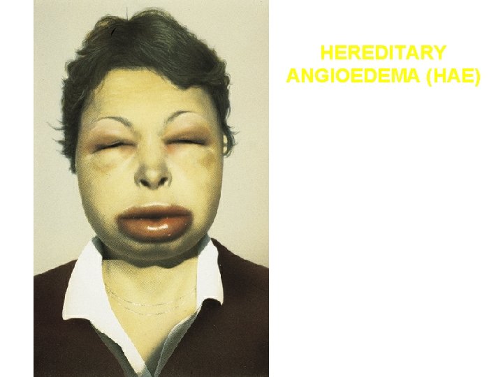 HEREDITARY ANGIOEDEMA (HAE) HEREDITARY ANGIOEDEMA (HAE)