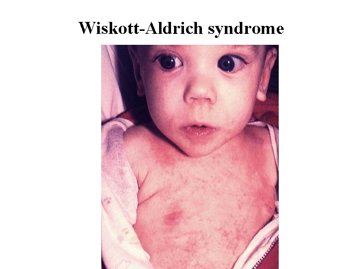 Wiskott-Aldrich syndrome Wiskott-Aldrich syndrome
