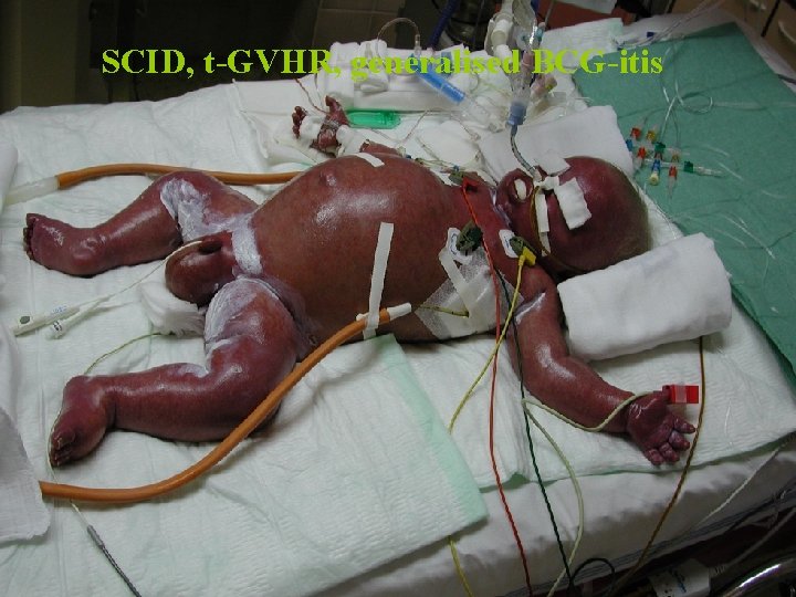 SCID, t-GVHR, generalised BCG-itis SCID, t-GVHR, generalised BCG-itis