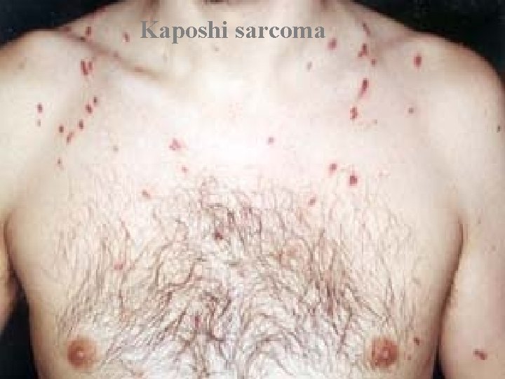 Kaposhi sarcoma Kaposhi sarcoma