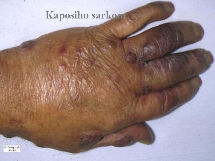 Kaposiho sarkom Kaposiho sarkom