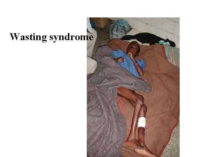Wasting syndrome Wasting syndrome