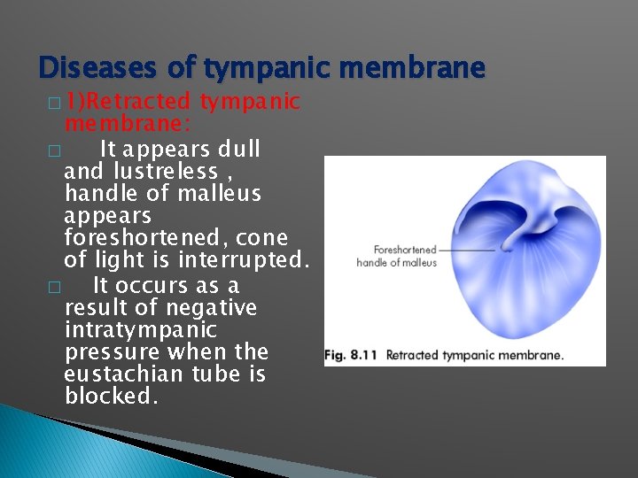 Diseases of tympanic membrane � 1)Retracted tympanic membrane: � It appears dull and lustreless