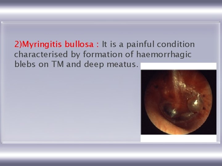 2)Myringitis bullosa : It is a painful condition characterised by formation of haemorrhagic blebs