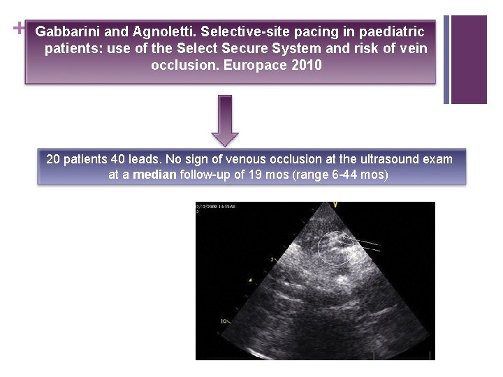 + Gabbarini and Agnoletti. Selective-site pacing in paediatric patients: use of the Select Secure