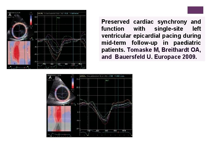 Preserved cardiac synchrony and function with single-site left ventricular epicardial pacing during mid-term follow-up