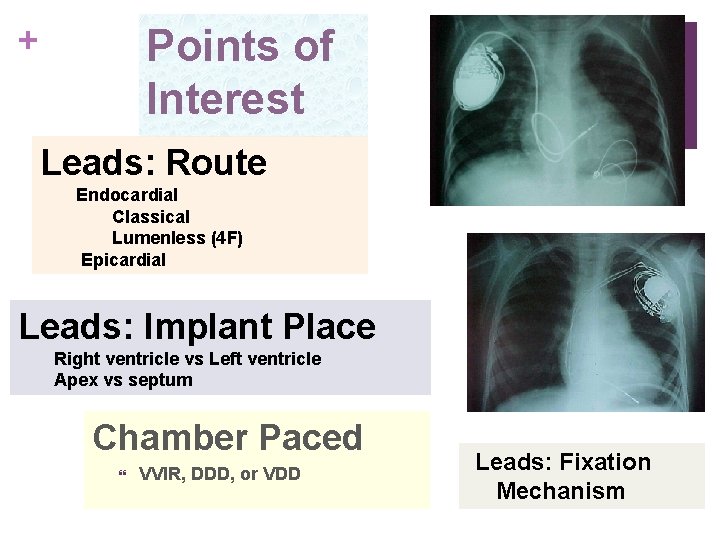 + Points of Interest Leads: Route Endocardial Classical Lumenless (4 F) Epicardial Leads: Implant