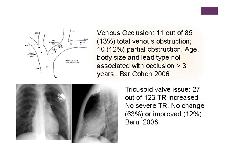 Venous Occlusion: 11 out of 85 (13%) total venous obstruction; 10 (12%) partial obstruction.