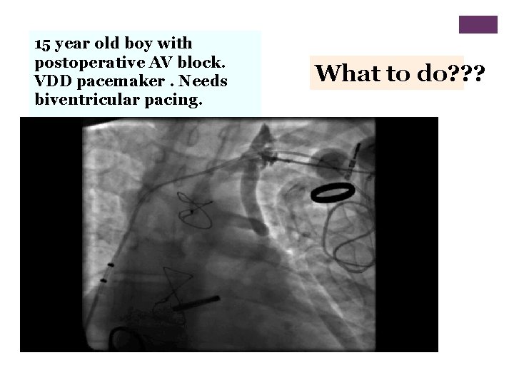 15 year old boy with postoperative AV block. VDD pacemaker. Needs biventricular pacing. What