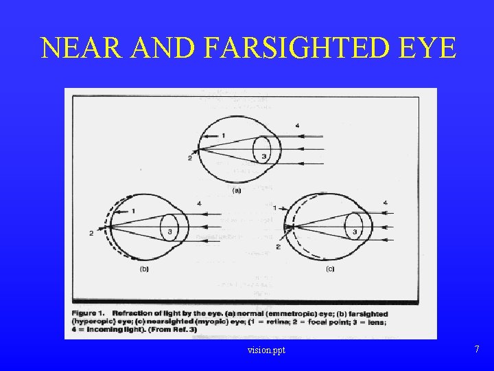 NEAR AND FARSIGHTED EYE vision. ppt 7 NEAR AND FARSIGHTED EYE vision. ppt 7