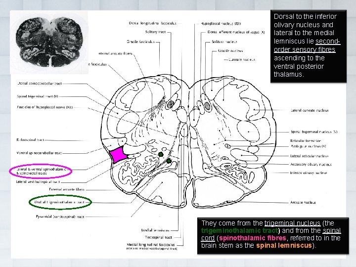Dorsal to the inferior olivary nucleus and lateral to the medial lemniscus lie second