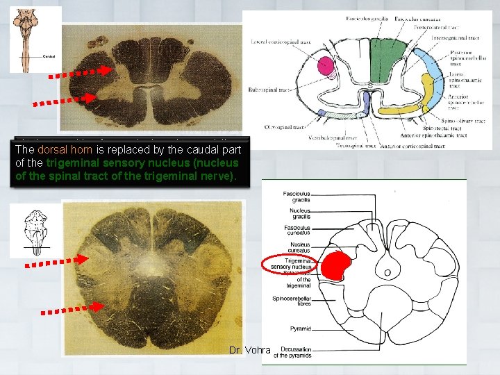 At the transition from spinal cord to medulla, The is replaced bymatter the caudal