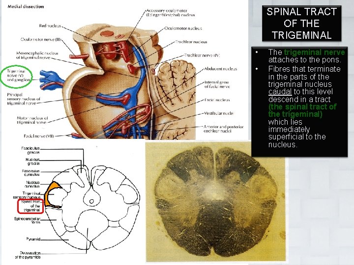 SPINAL TRACT OF THE TRIGEMINAL • • Dr. Vohra The trigeminal nerve attaches to