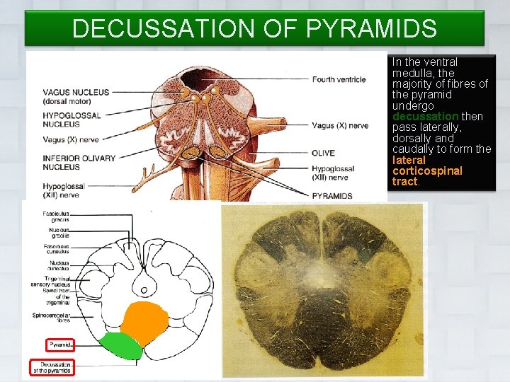 DECUSSATION OF PYRAMIDS In the ventral medulla, the majority of fibres of the pyramid