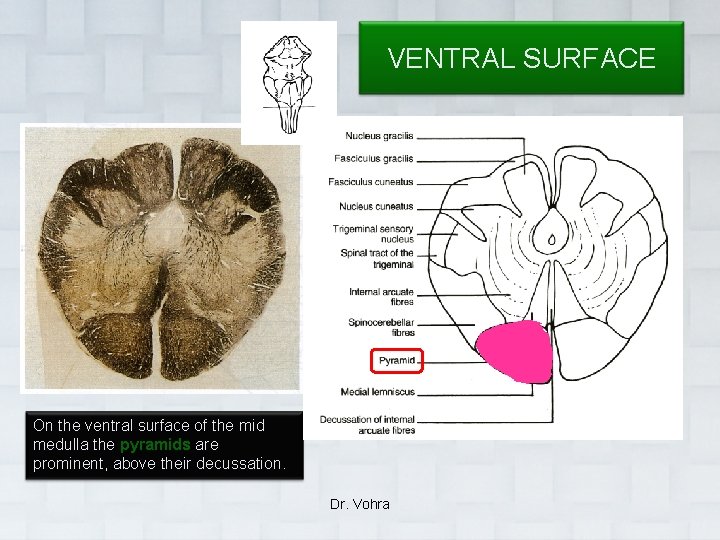 VENTRAL SURFACE On the ventral surface of the mid medulla the pyramids are prominent,