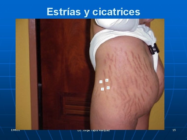 Estrías y cicatrices EMNSI Lic. Jorge Tapia Márquez 15 