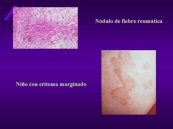 Nódulo de fiebre reumática Niño con eritema marginado 