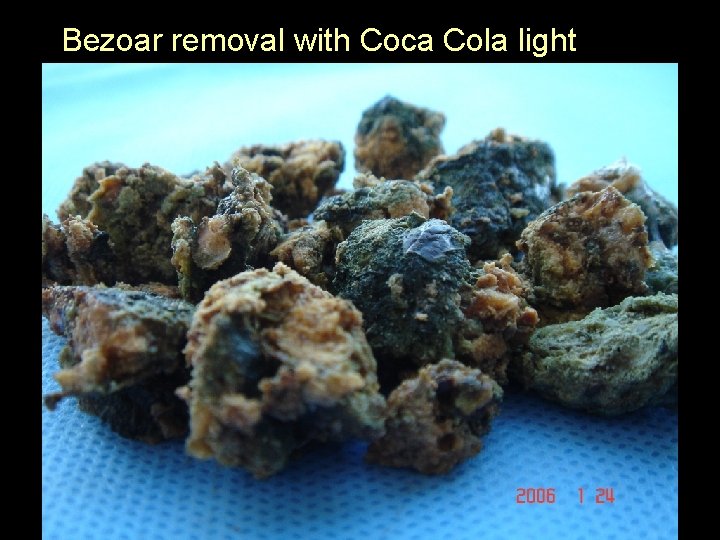 Bezoar removal with Coca Cola light 