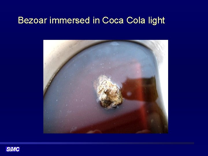Bezoar immersed in Coca Cola light 