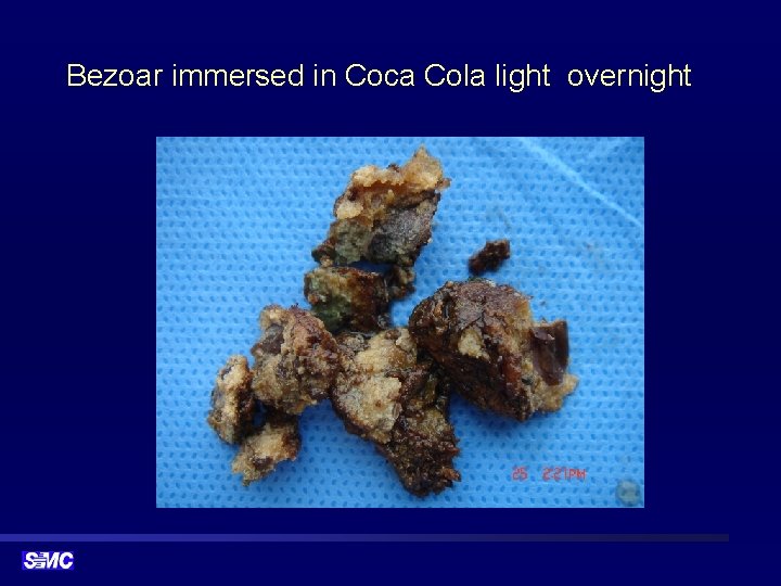 Bezoar immersed in Coca Cola light overnight 