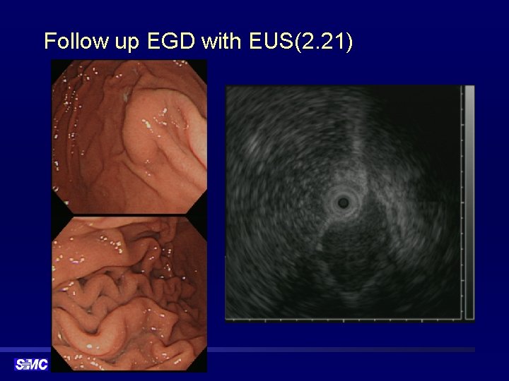 Follow up EGD with EUS(2. 21) 