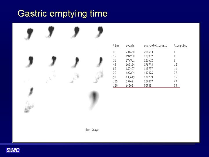 Gastric emptying time 
