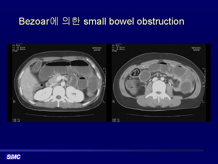 Bezoar에 의한 small bowel obstruction 