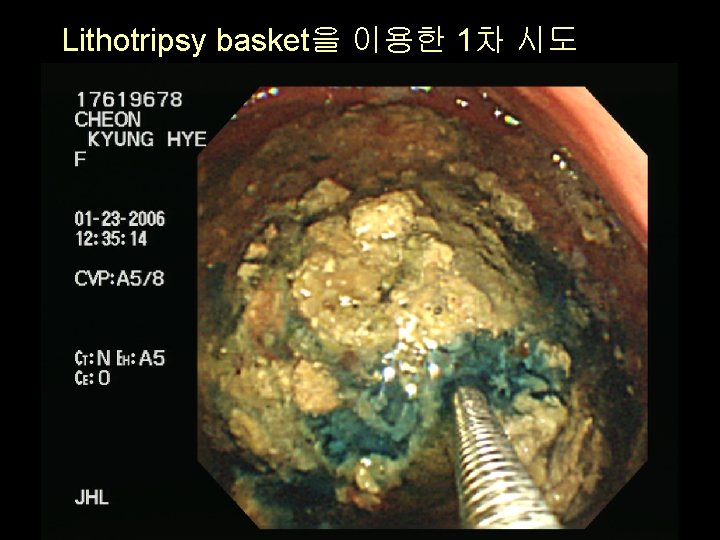 Lithotripsy basket을 이용한 1차 시도 