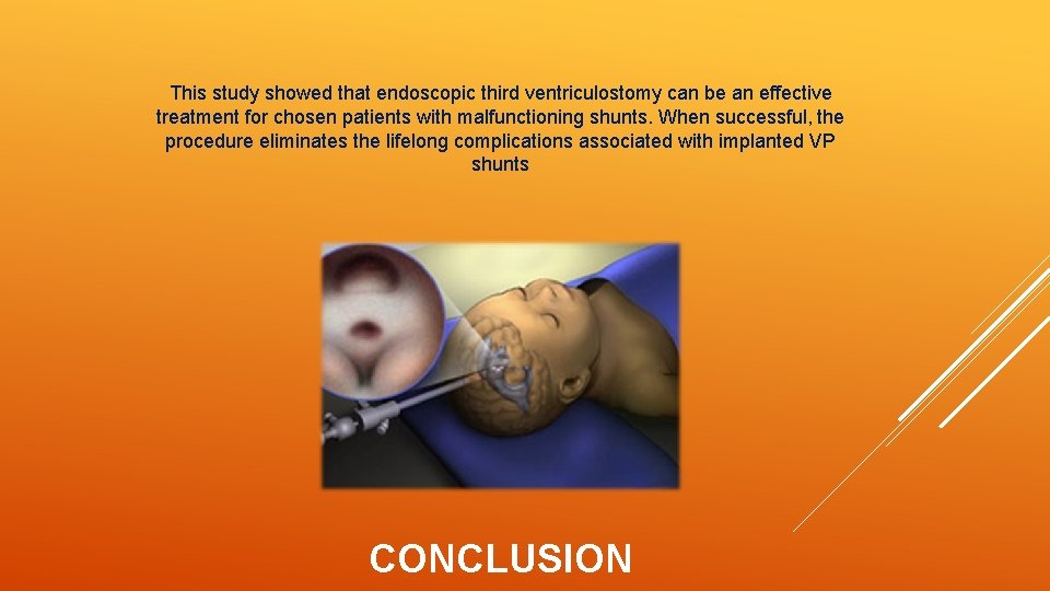 This study showed that endoscopic third ventriculostomy can be an effective treatment for chosen