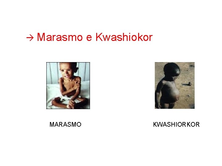  Marasmo MARASMO e Kwashiokor KWASHIORKOR 