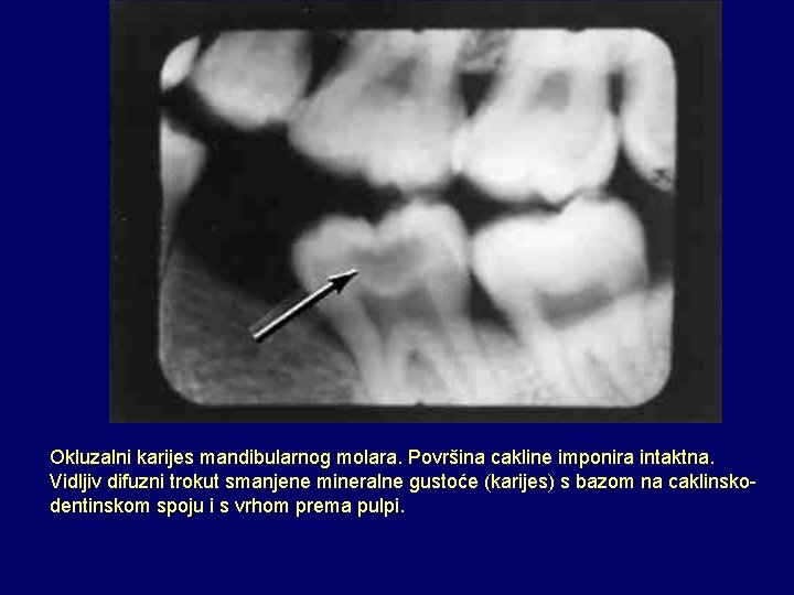 Okluzalni karijes mandibularnog molara. Površina cakline imponira intaktna. Vidljiv difuzni trokut smanjene mineralne gustoće