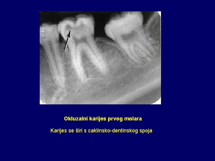 Okluzalni karijes prvog molara Karijes se širi s caklinsko-dentinskog spoja 