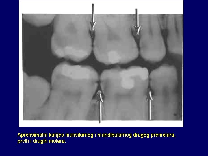 Aproksimalni karijes maksilarnog i mandibularnog drugog premolara, prvih i drugih molara. 
